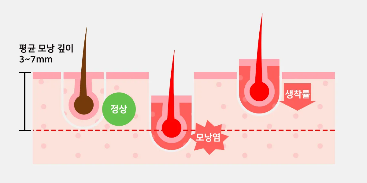 모낭 이식 깊이 — 생착률을 결정하는 핵심 요소