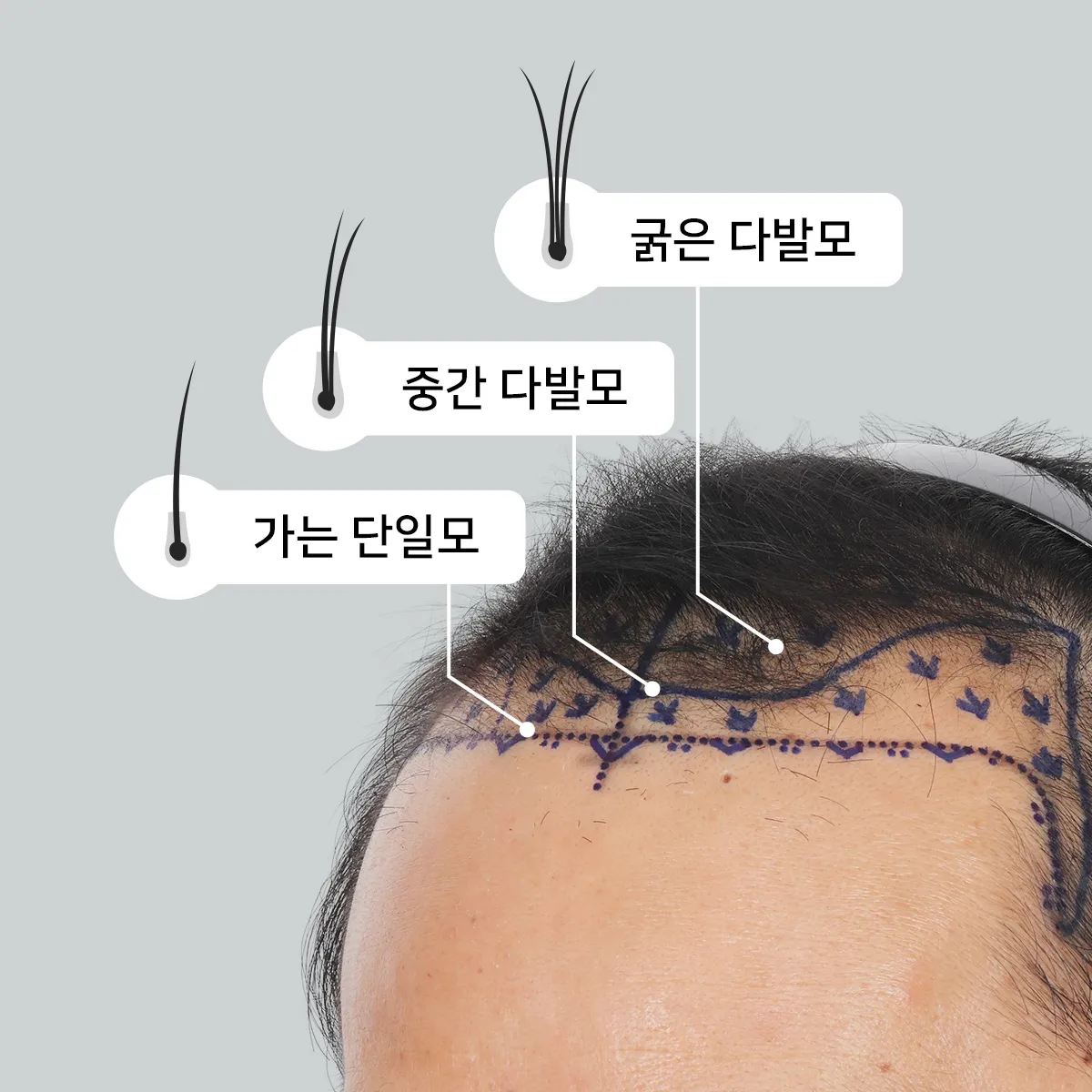 모발이식 그라데이션 기법 — 헤어라인 앞부분에 단일모, 뒤쪽에 다발모 배치로 자연스러운 밀도를 설계하는 비절개 모발이식 디자인