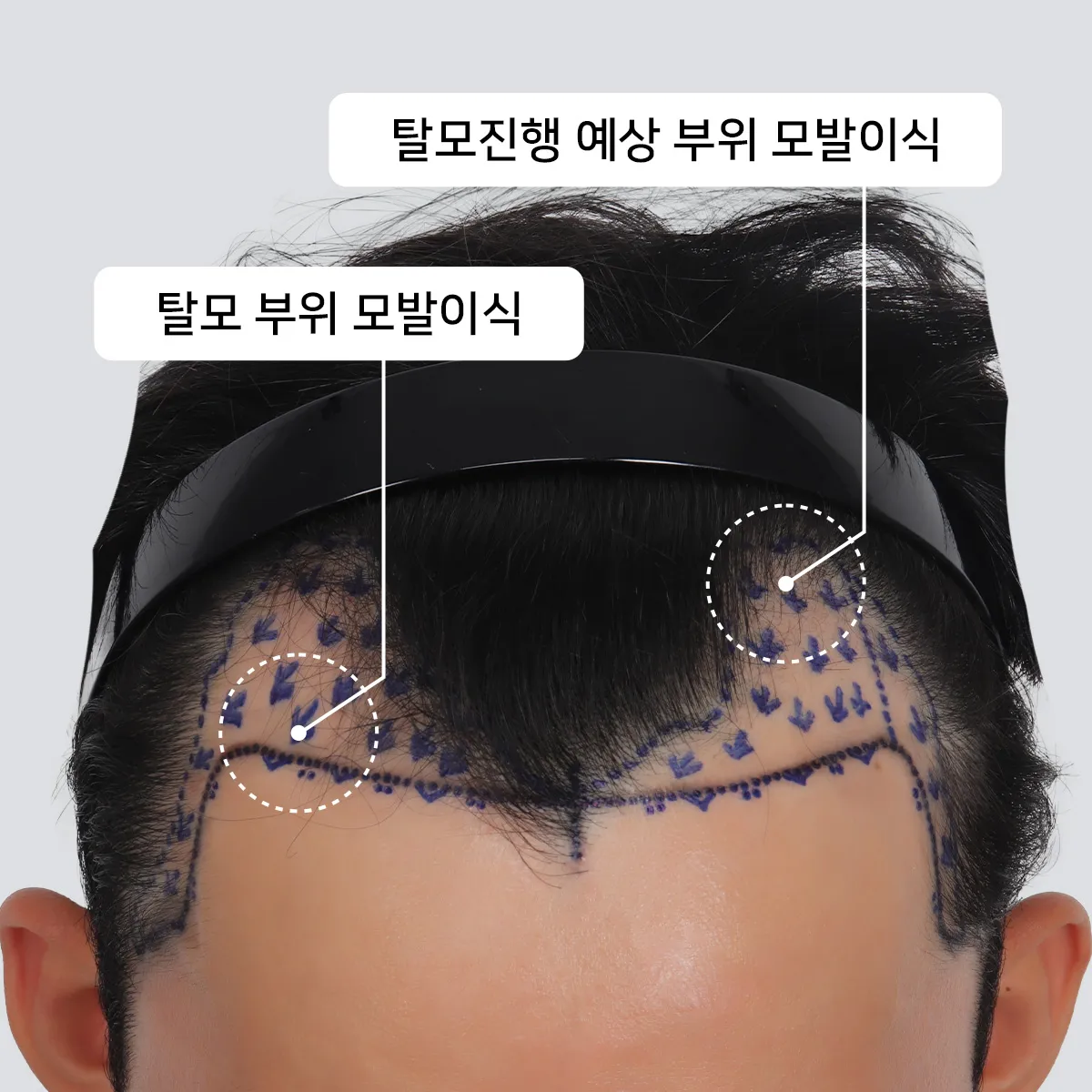 탈모 진행 예상 부위를 고려한 모발이식 계획 — 비절개 모발이식에서 미래 탈모 범위를 예측하여 지속가능한 공여부를 설계하는 과정