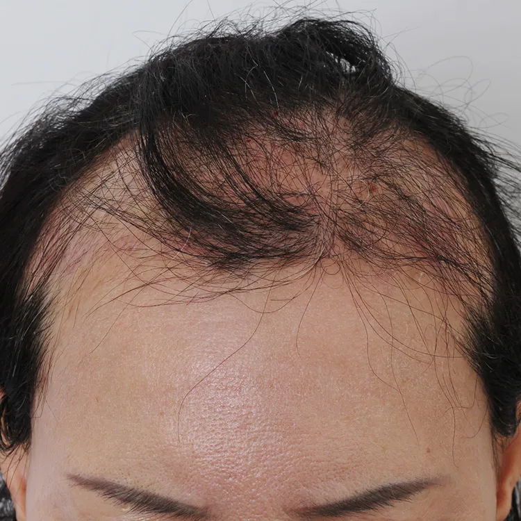 원형탈모 지루성두피염이 함께 있다면? 치료 순서 3가지